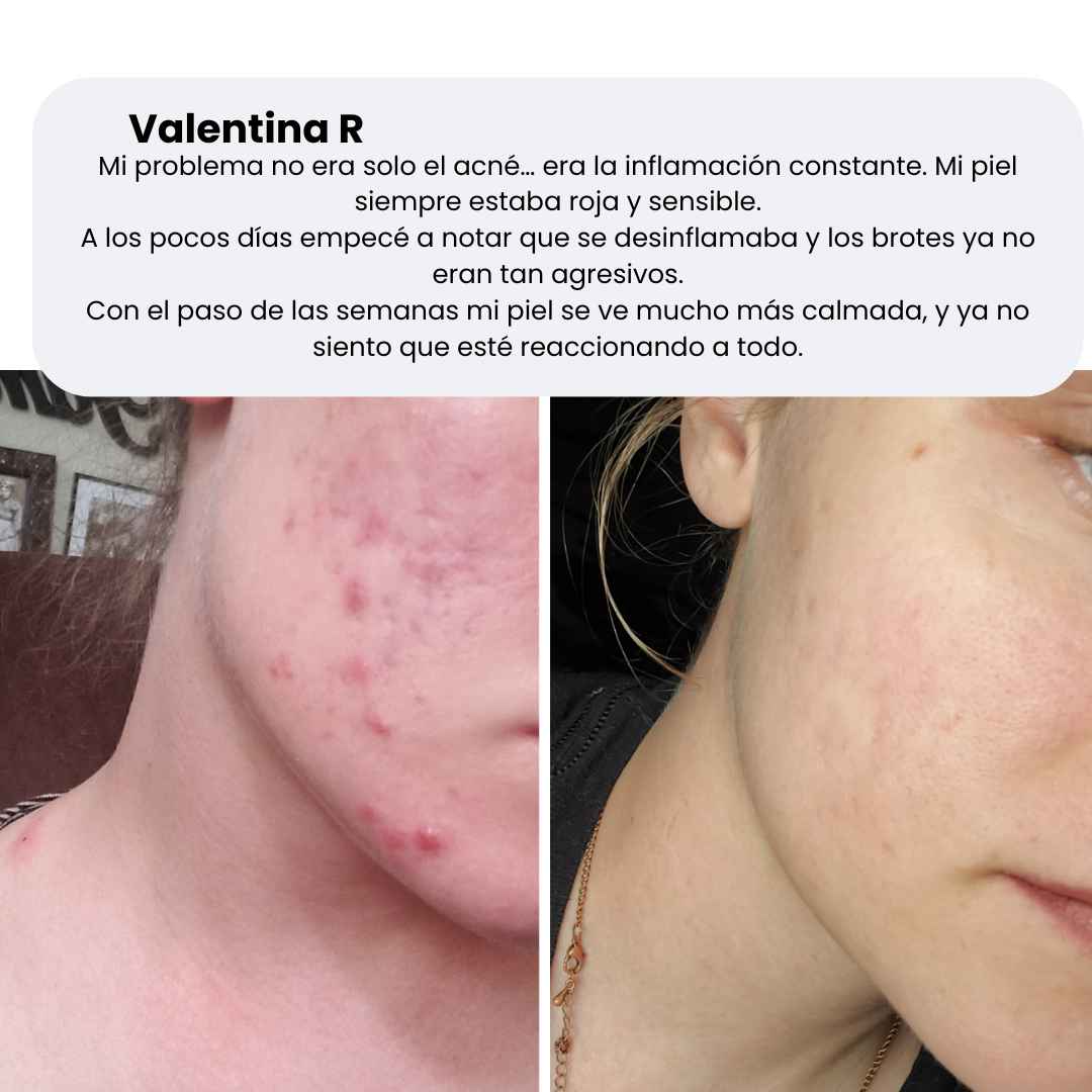 CLEARSTEAM CONTROL ACNE X90